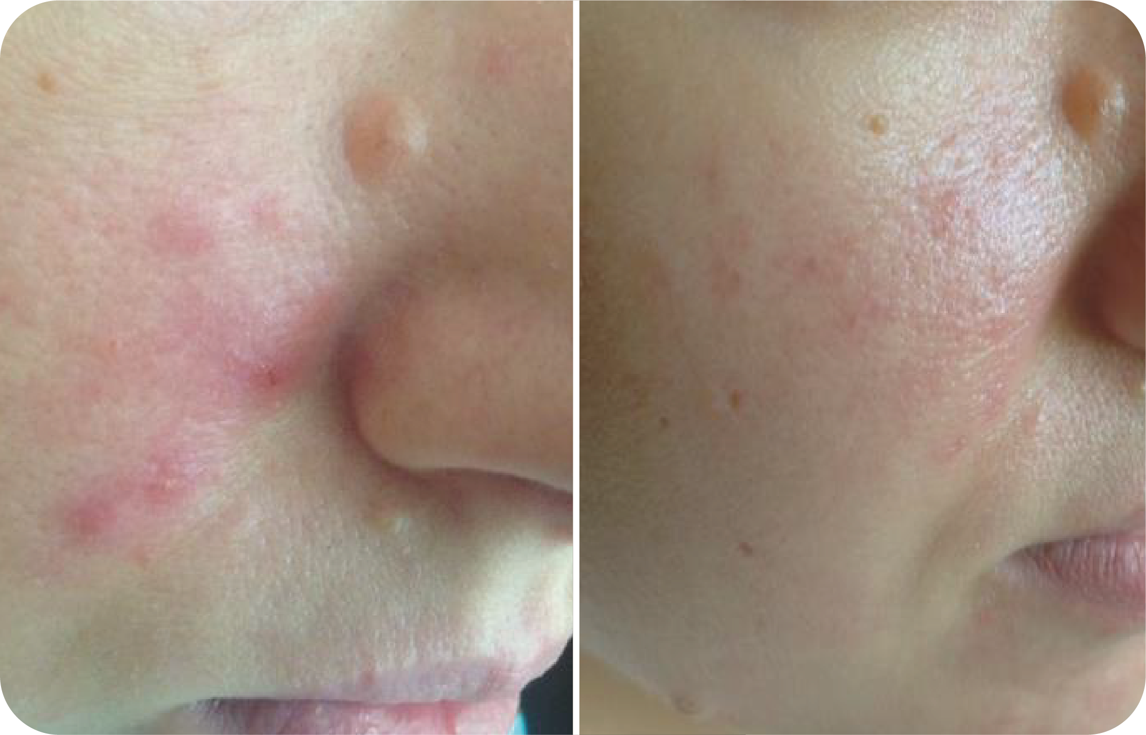 Antes y después - Dermatitis
